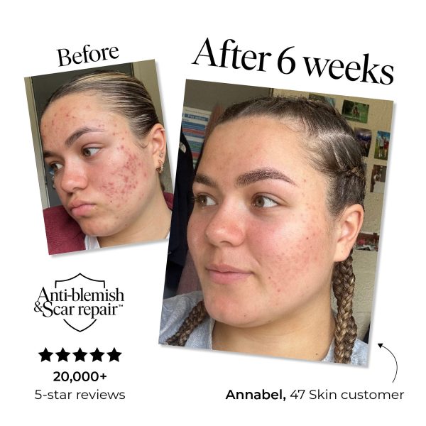 Trial Size Anti-Blemish & Scar Repair Serum (15ml – 2 Weeks)